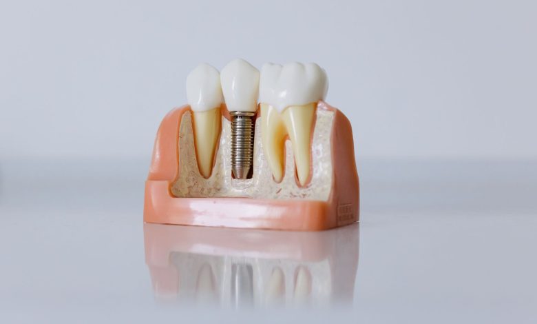 Detailed dental implant model showcasing teeth structure for educational purposes.